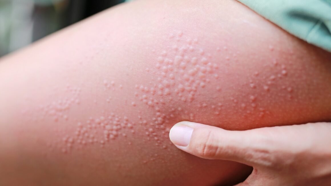 Was ist Nesselsucht? Ursachen, Symptome und Behandlung einfach erklärt
