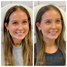 masseter botox vorher nachher