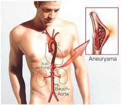 aneurysma aorta