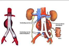 aneurysma aorta