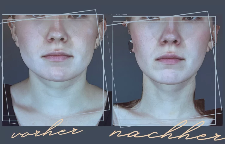 masseter botox vorher nachher